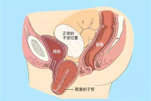 【產(chǎn)后修復(fù)】盆腔臟器脫垂，你有嗎？