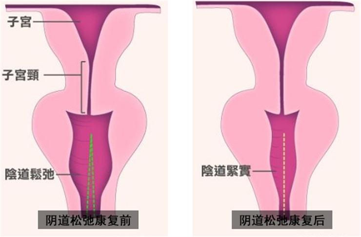 【盆底肌修復(fù)】盆底不修復(fù)，老來后患無窮