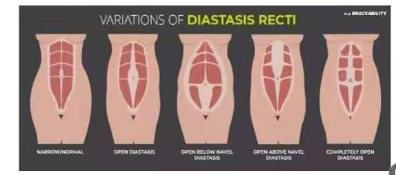 腹直肌分離如何分類？腹直肌分離修復(fù)