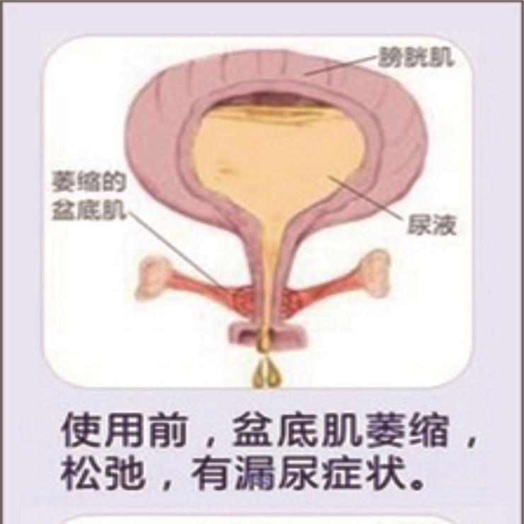 產(chǎn)后盆底肌康復(fù)|“社交癌”盯上你了嗎？