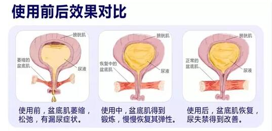 盆底康復(fù)治療怎么做？產(chǎn)后盆底功能檢測很重要