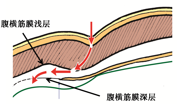 產后腹直肌分離如何康復，腹直肌修復那點事