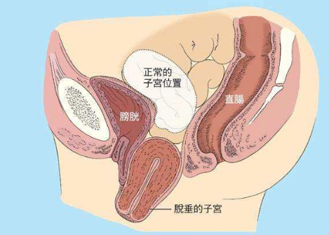 人們常說，產(chǎn)后女性做好盆底肌修復(fù)是關(guān)鍵，但盆腔器官的脫垂你也得注意