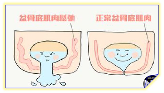 盆底康復(fù)治療怎么做，盆底肌修復(fù)常見的十大問題（中）