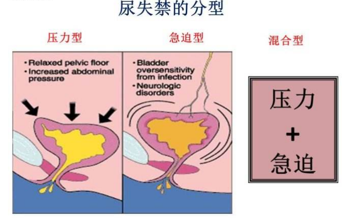 產(chǎn)后盆底肌怎么修復|尿失禁的類型，傻傻分不清