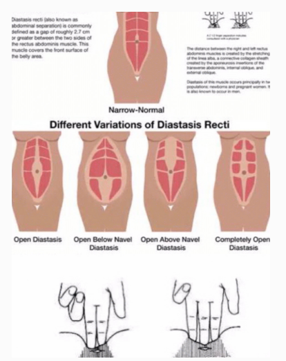 腹直肌分離修復(fù)詳細(xì)解答，精準(zhǔn)評估結(jié)合自我修復(fù)