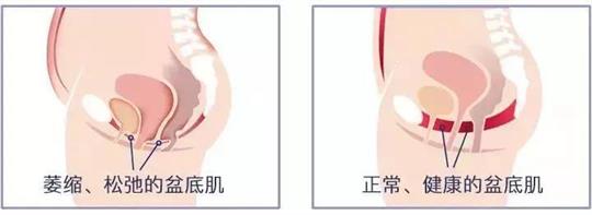 尿失禁治療儀器，不再詢問盆底康復(fù)治療有用嗎這類無意義問題