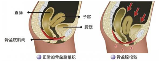 盆底功能檢測很重要，盆底肌松弛了會有什么表現(xiàn)呢？