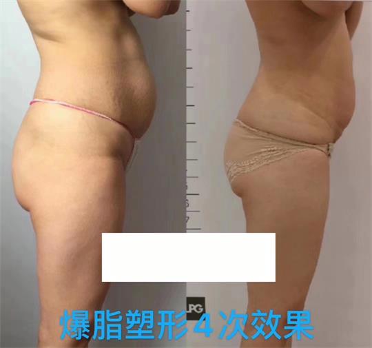 產(chǎn)后塑形美雕儀，生完孩子真的很難恢復(fù)身材？未必……