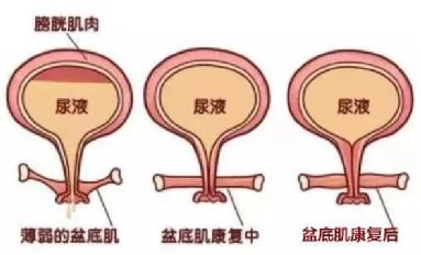 尿頻尿急尿不盡？或者可以試試盆底肌修復(fù)儀器電刺激