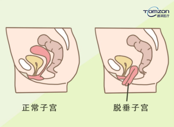 盆底肌修復儀器是如何促進恢復的？