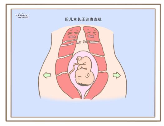 腹直肌分離可以使用盆底肌修復(fù)儀器嗎？