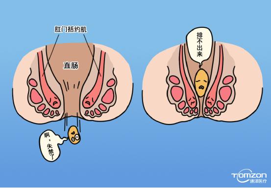 便秘跟盆底肌有什么關(guān)系，能用盆底肌修復(fù)儀器治療嗎？