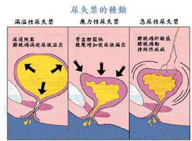 產(chǎn)后盆底肌修復