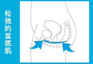 盆底肌修復(fù)